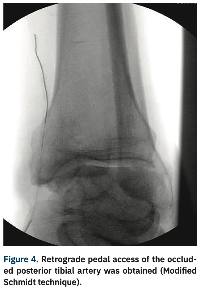 Modified CART Technique How to Maximize the Efficiency of CART and